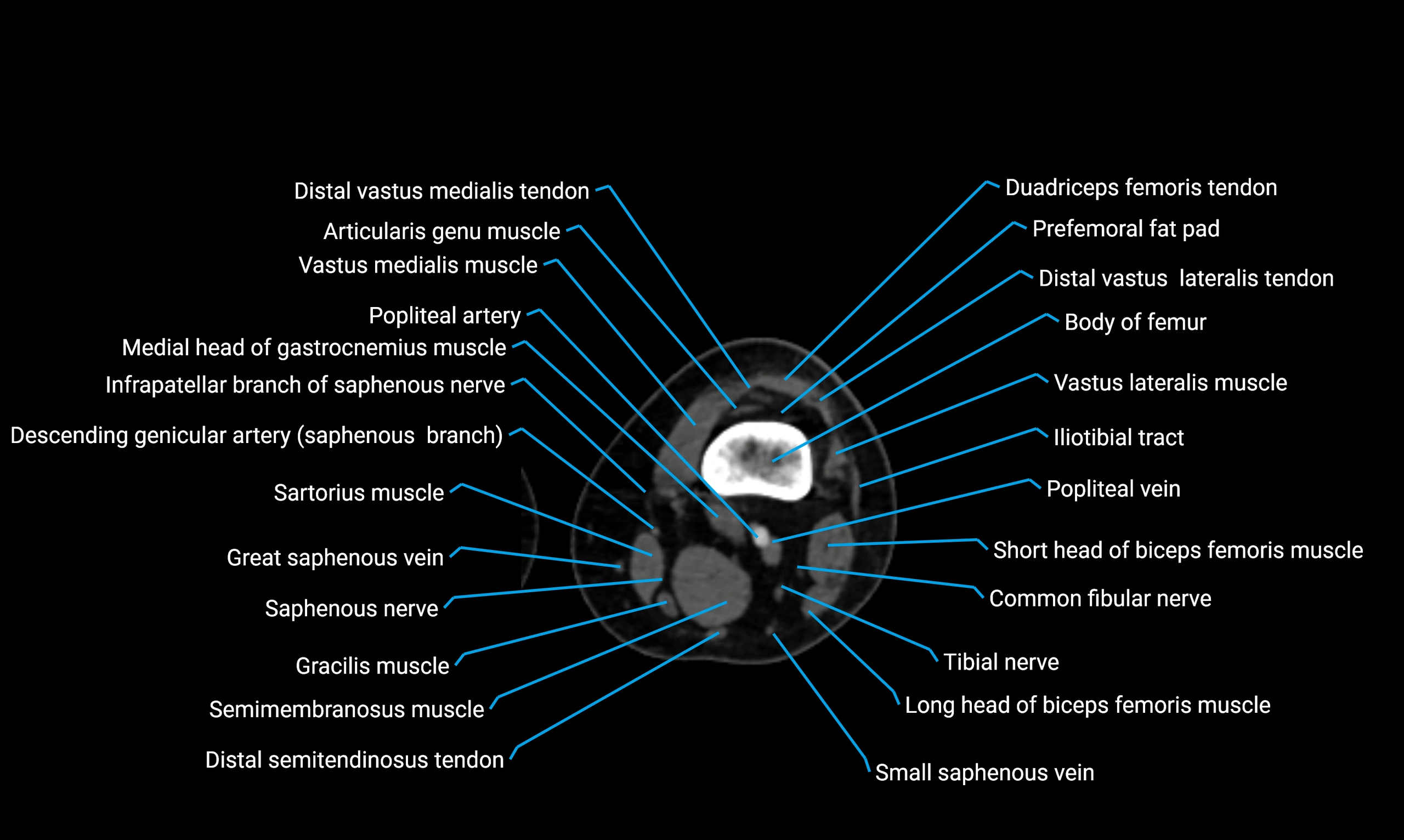 CT thigh axial cross sectional anatomy labelled image_78 (2).webp